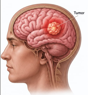Neuro-oncology